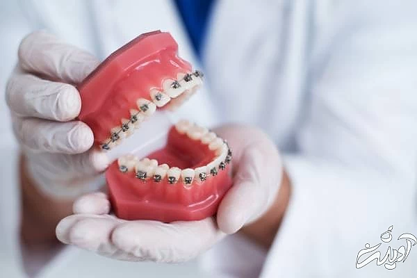 معایب ارتودنسی